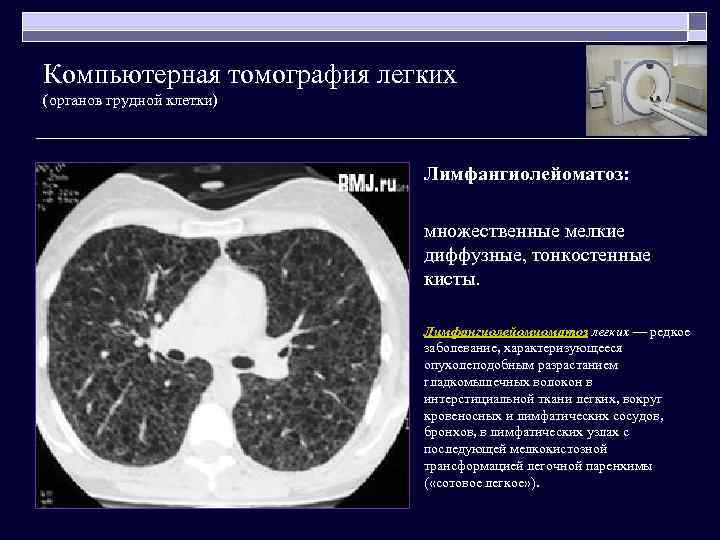 Компьютерная томография легких (органов грудной клетки) Лимфангиолейоматоз: множественные мелкие диффузные, тонкостенные кисты. Лимфангиолейомиоматоз легких