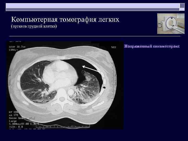 Компьютерная томография легких (органов грудной клетки) Напряженный пневмоторакс 