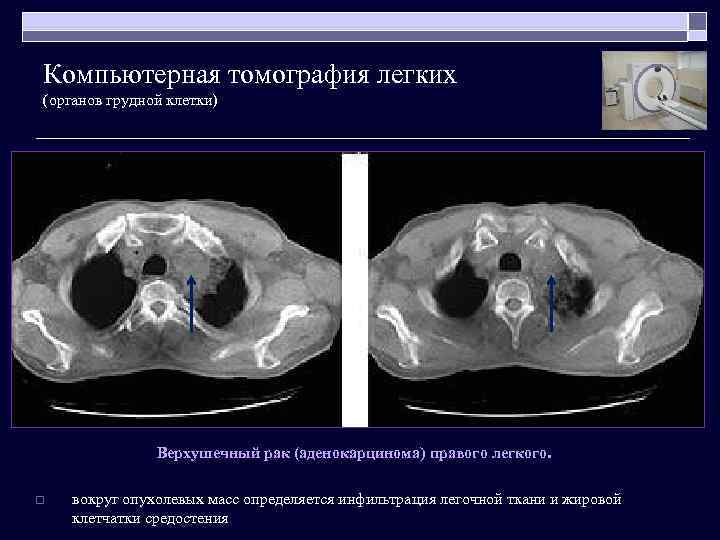 Компьютерная томография легких (органов грудной клетки) Верхушечный рак (аденокарцинома) правого легкого. o вокруг опухолевых