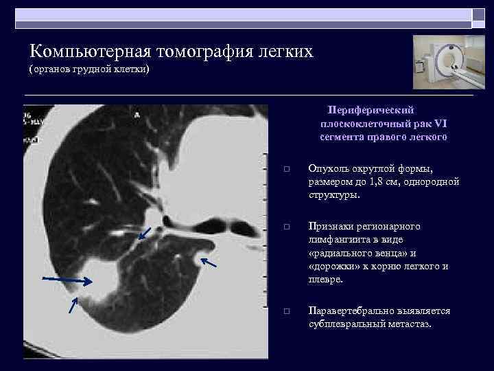 Компьютерная томография легких (органов грудной клетки) Периферический плоскоклеточный рак VI сегмента правого легкого o