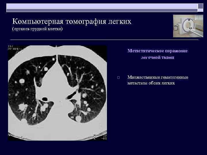 Компьютерная томография легких (органов грудной клетки) Метастатическое поражение легочной ткани o Множественные гематогенные метастазы