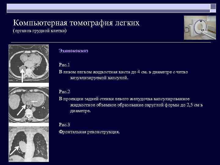 Компьютерная томография легких (органов грудной клетки) Эхинококкоз Рис. 1 В левом легком жидкостная киста