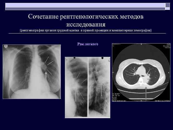 Сочетание рентгенологических методов исследования (рентгенография органов грудной клетки в прямой проекции и компьютерная томография)