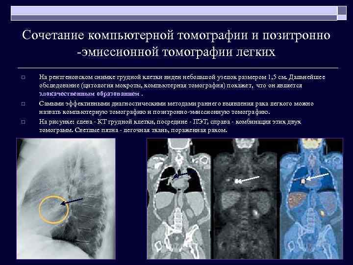 Сочетание компьютерной томографии и позитронно -эмиссионной томографии легких o o o На рентгеновском снимке