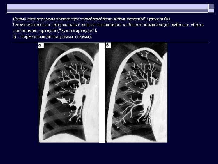 Схема ангиограммы легких при тромбоэмболии ветви легочной артерии (а). Стрелкой показан артериальный дефект наполнения