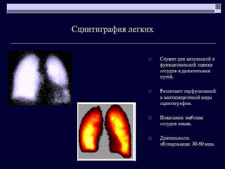 Сцинтиграфия легких o Служит для визуальной и функциональной оценки сосудов и дыхательных путей. o