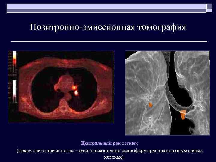 Позитронно-эмиссионная томография Центральный рак легкого (яркие светящиеся пятна – очаги накопления радиофармпрепарата в опухолевых