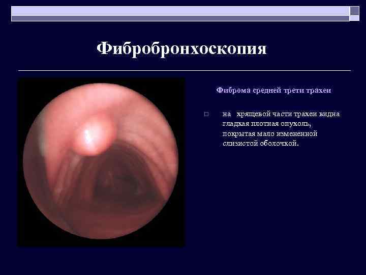 Фибробронхоскопия Фиброма средней трети трахеи o на хрящевой части трахеи видна гладкая плотная опухоль,