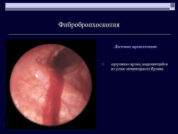 Фибробронхоскопия Легочное кровотечение o «дорожка» крови, выделяющейся из устья сегментарного бронха 