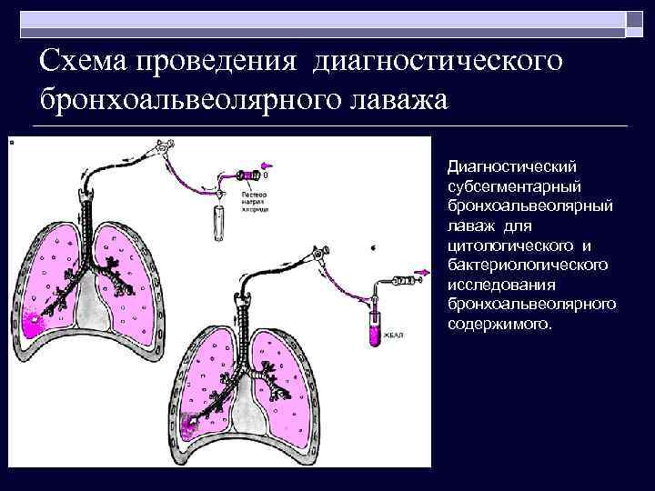 Схема проведения диагностического бронхоальвеолярного лаважа Диагностический субсегментарный бронхоальвеолярный лаваж для цитологического и бактериологического исследования
