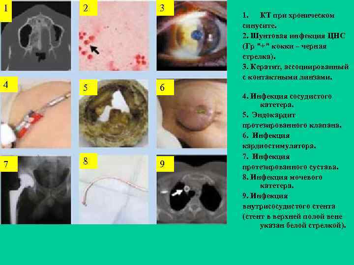 1 2 3 4 5 6 8 9 7 1. КТ при хроническом синусите.