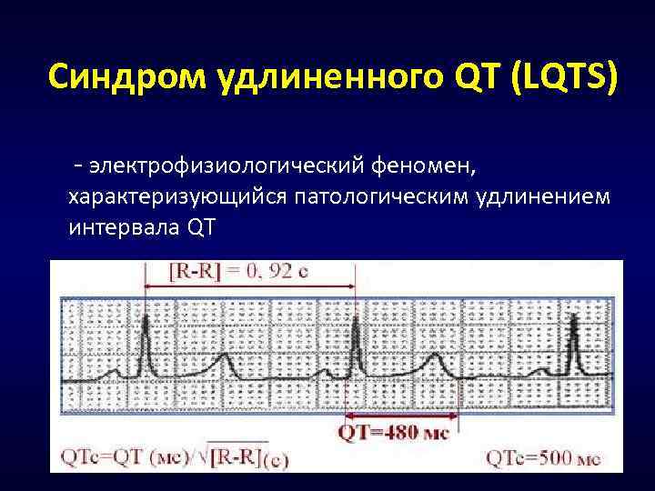 Синдром удлиненного QT (LQTS) - электрофизиологический феномен, характеризующийся патологическим удлинением интервала QT 