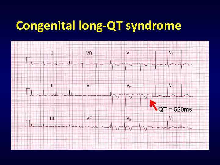 Congenital long-QT syndrome QT = 520 ms 