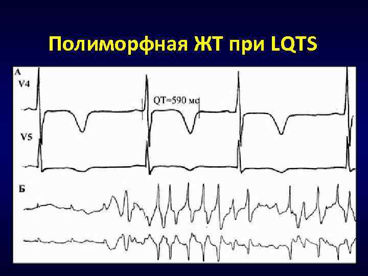 Полиморфная ЖТ при LQTS 