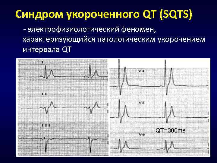 Синдром укороченного QT (SQTS) - электрофизиологический феномен, характеризующийся патологическим укорочением интервала QT QT=300 ms