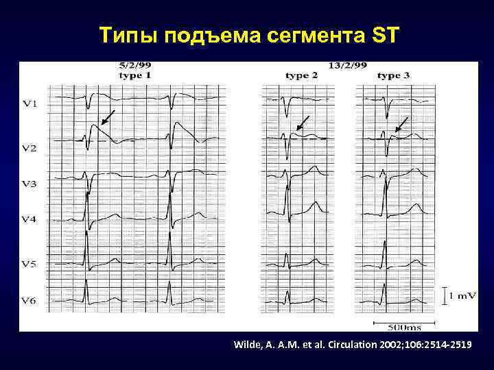 Типы подъема сегмента ST Wilde, A. A. M. et al. Circulation 2002; 106: 2514