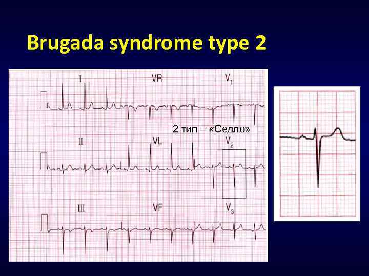 Brugada syndrome type 2 2 тип – «Седло» 