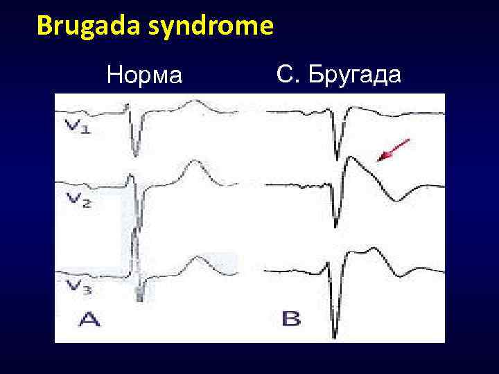 Brugada syndrome Норма С. Бругада 