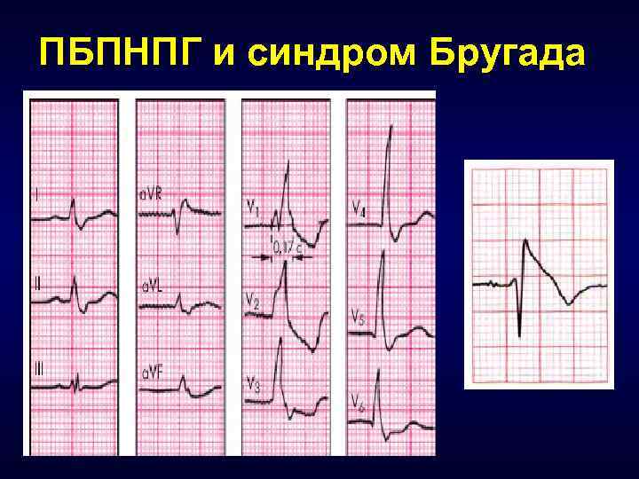 ПБПНПГ и синдром Бругада 