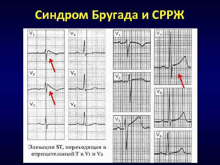 Синдром Бругада и СРРЖ Элевация ST, переходящая в отрицательный Т в V 1 и