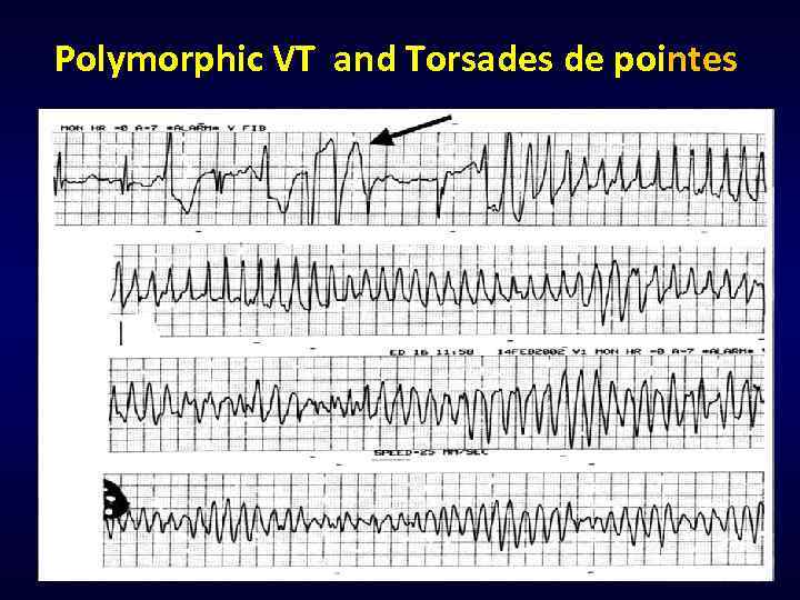 Рolymorphic VT and Torsades de pointes 