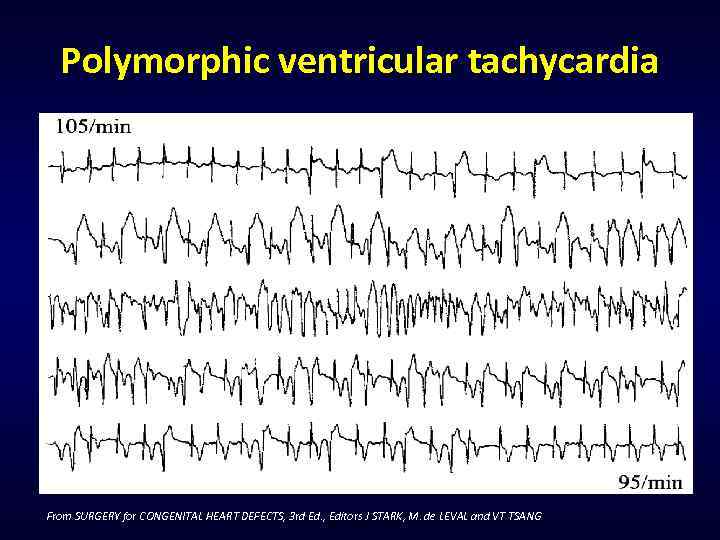 Polymorphic ventricular tachycardia From SURGERY for CONGENITAL HEART DEFECTS, 3 rd Ed. , Editors