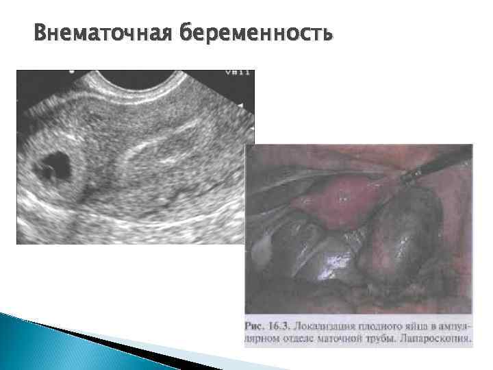 Внематочная беременность 