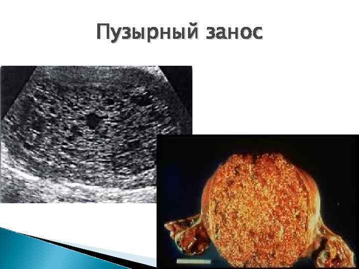 Пузырный занос 