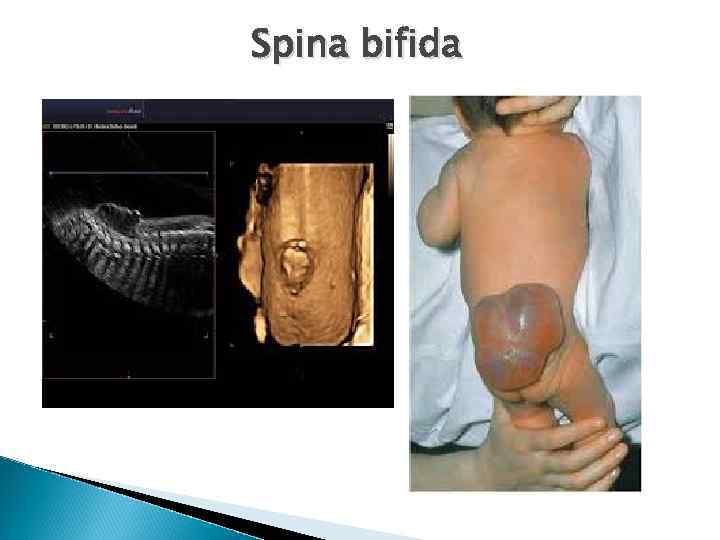 Spina bifida 