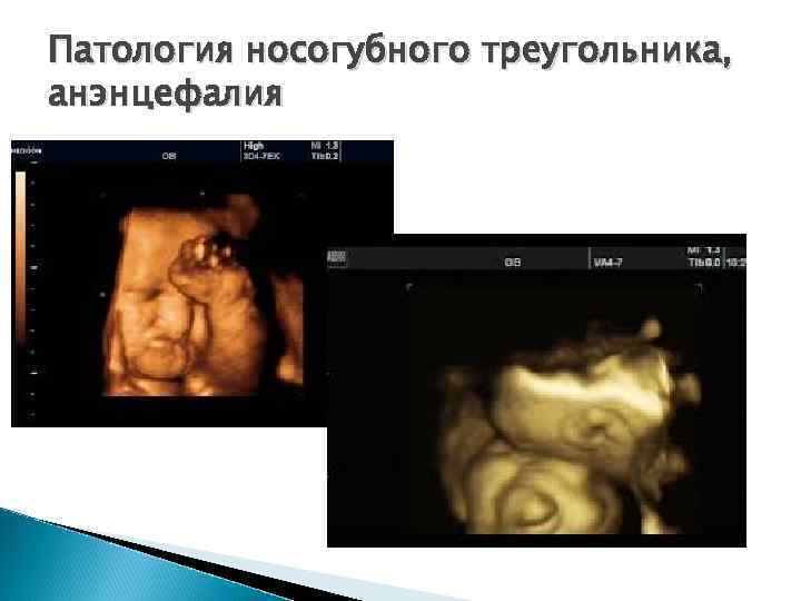 Патология носогубного треугольника, анэнцефалия 