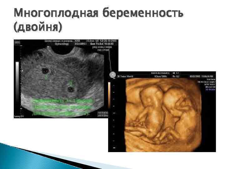 Многоплодная беременность (двойня) 