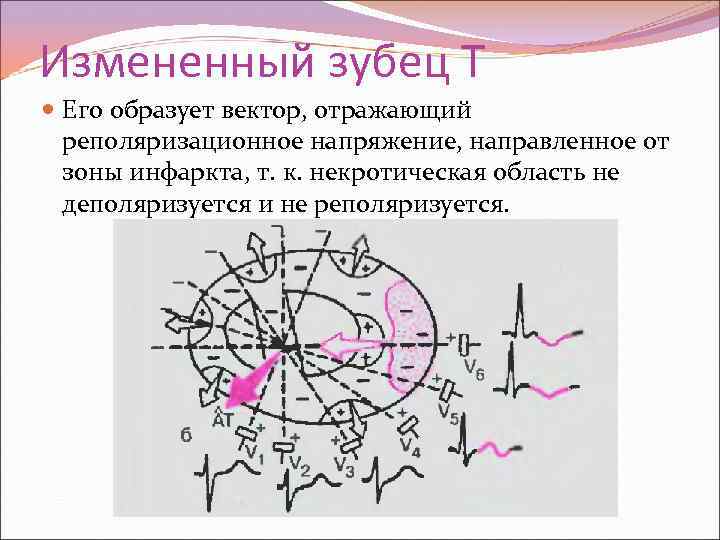 Измененный зубец Т Его образует вектор, отражающий реполяризационное напряжение, направленное от зоны инфаркта, т.