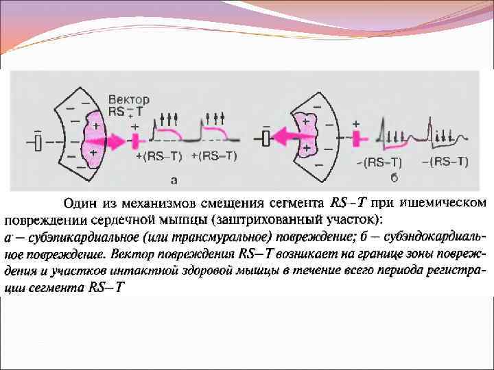 Основным экг признаком некроза сердечной мышцы является. Некроз сердечной мышцы на ЭКГ. ЭКГ при некрозе сердечной мышцы. Основной ЭКГ-признак некроза сердечной мышцы.