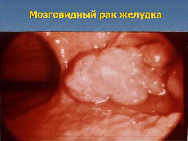 Мозговидный рак желудка 