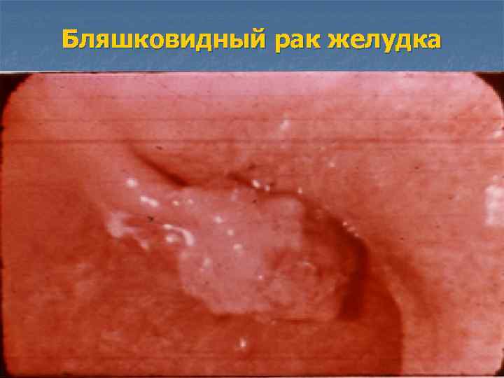 Бляшковидный рак желудка 