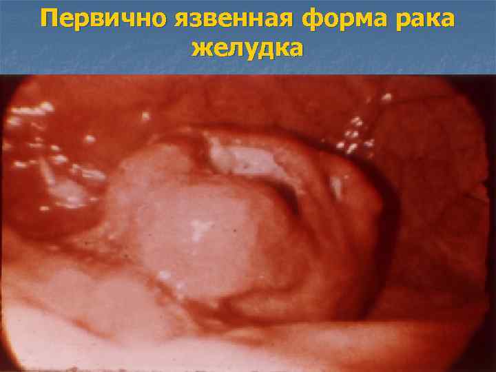 Первично язвенная форма рака желудка 