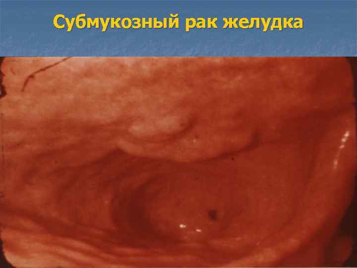 Субмукозный рак желудка 