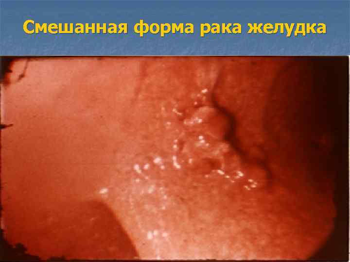 Смешанная форма рака желудка 