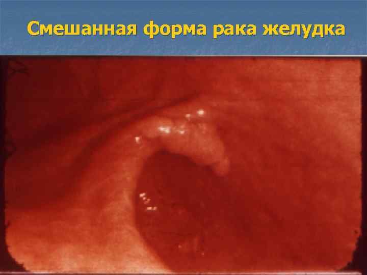 Смешанная форма рака желудка 