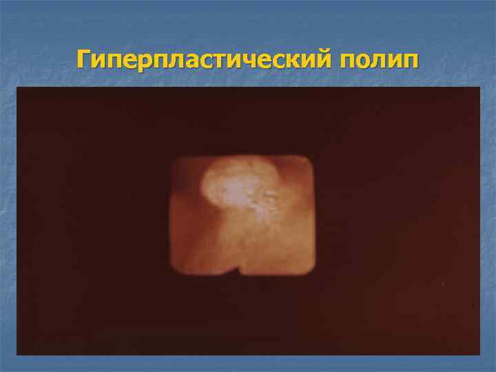 Гиперпластический полип 