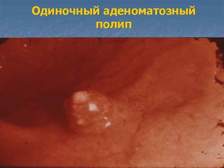 Одиночный аденоматозный полип 