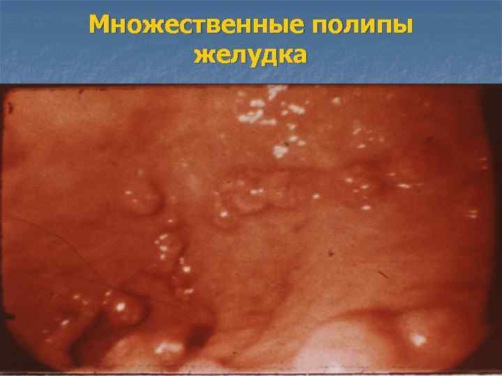 Множественные полипы желудка 