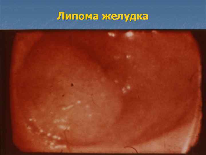 Липома желудка 