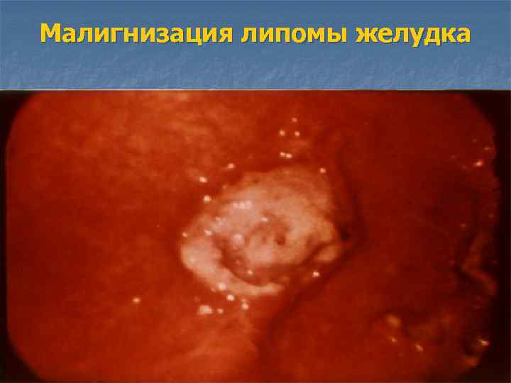 Малигнизация липомы желудка 
