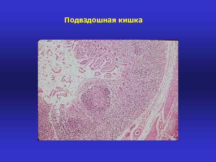 Подвздошная кишка 