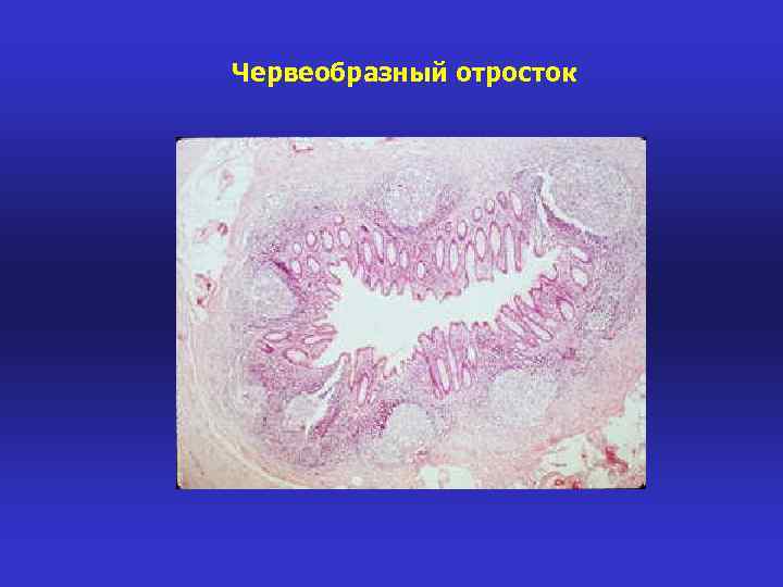 Червеобразный отросток 