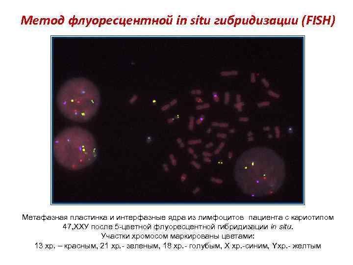 Метод флуоресцентной in situ гибридизации (FISH) Метафазная пластинка и интерфазные ядра из лимфоцитов пациента