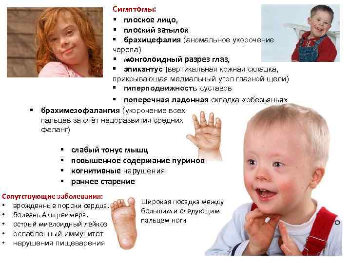Симптомы: § плоское лицо, § плоский затылок § брахицефалия (аномальное укорочение черепа) § монголоидный