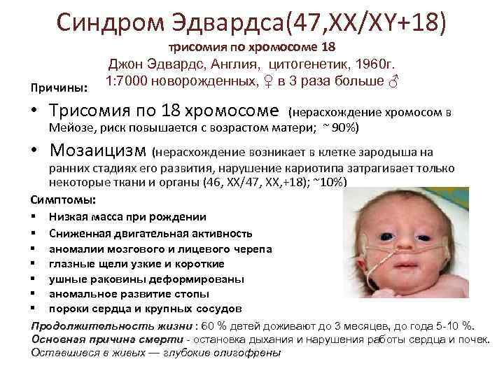 Синдром Эдвардса(47, ХХ/ХY+18) Причины: трисомия по хромосоме 18 Джон Эдвардс, Англия, цитогенетик, 1960 г.
