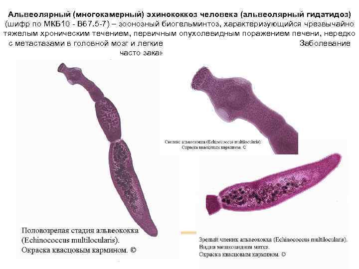Альвеолярный (многокамерный) эхинококкоз человека (альвеолярный гидатидоз) (шифр по МКБ 10 - B 67. 5